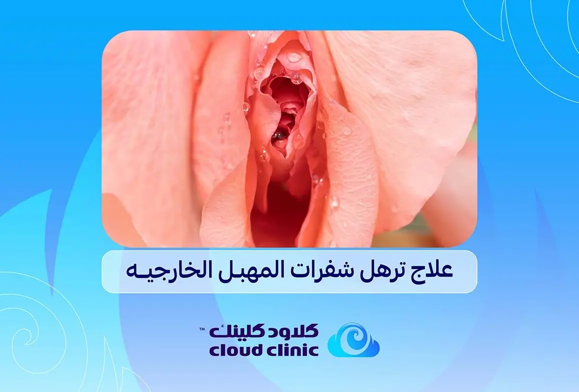 علاج ترهل شفرات المهبل الخارجية | كلاود كلينيك